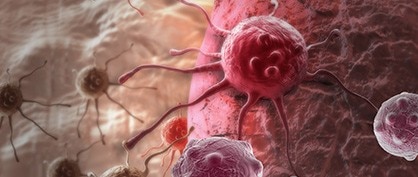 Krebsgeschichte schreiben - CAR T-Zell-Therapie